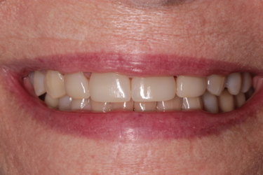 After Smile Photo